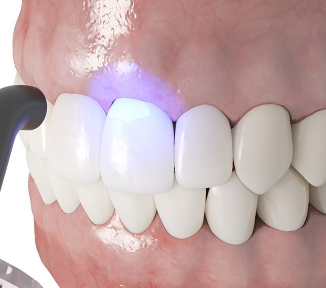 Illustration of UV light being used for cosmetic dental bonding in Edmond, OK
