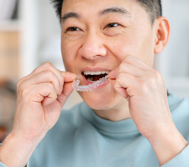 Closeup of smiling man placing clear aligners in his mouth