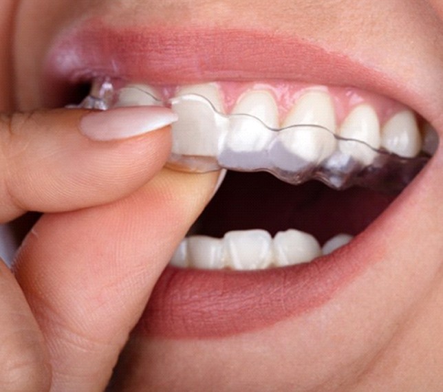 close-up of someone putting a clear aligner in their mouth