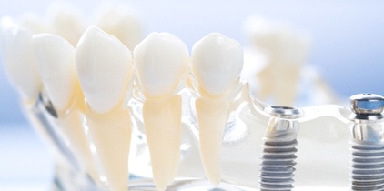 Implants to support a dental bridge
