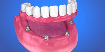 Digital model for implant supported denture