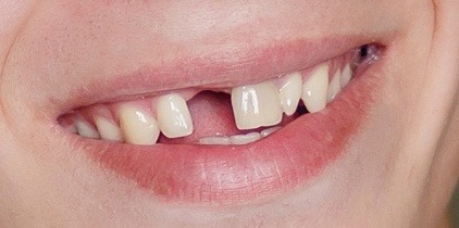 Closeup of smile with knocked out front tooth