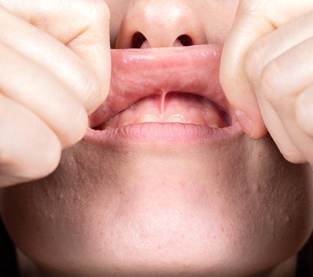 person lifting up their lip to show their gums
