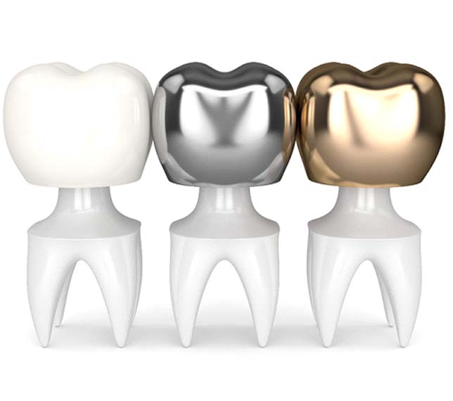 Types of dental crowns in Edmond 