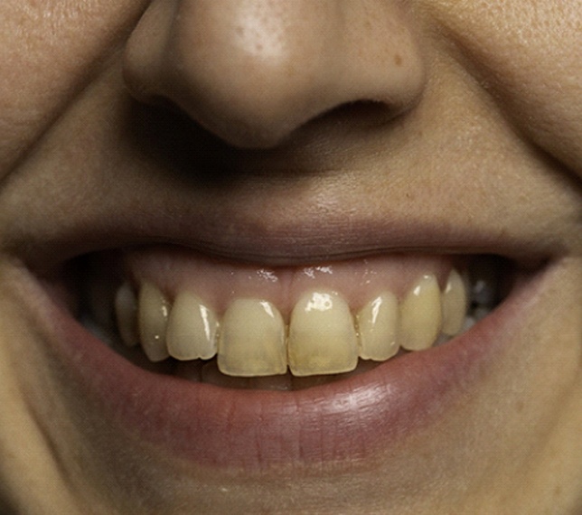 Close-up of a smile with stained teeth