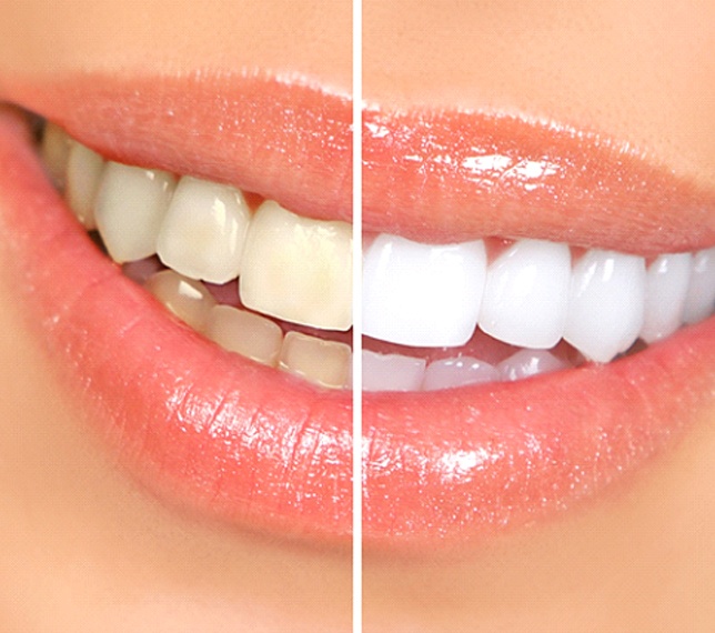 Before and after photos of teeth whitening
