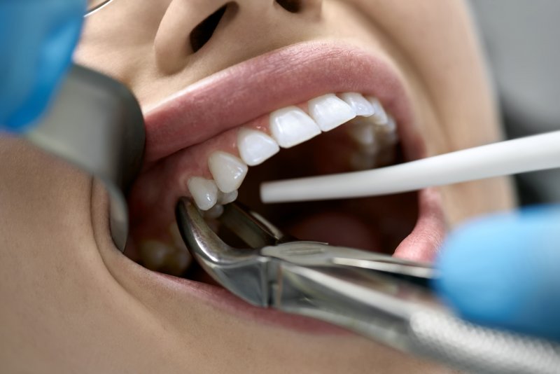 A dentist performing a tooth extraction on a patient